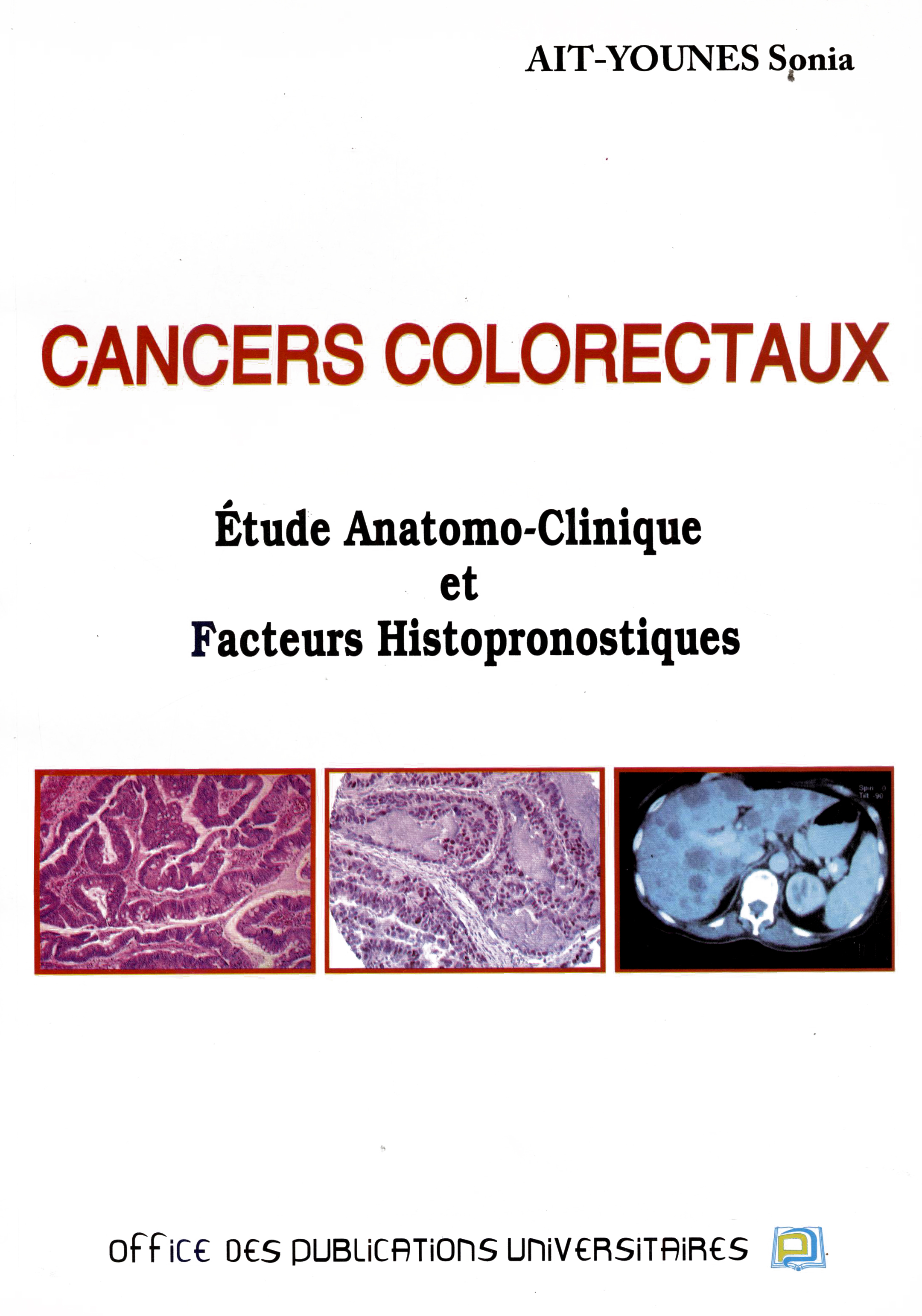 CANCERS COLORECTAUX Étude Anatomo-Clinique et Facteurs Histopronostiques
