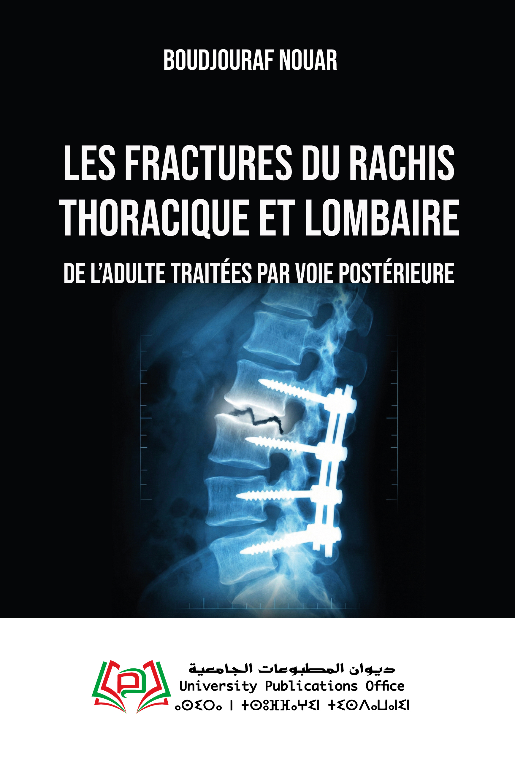 Les fractures du rachis thoracique et lombaire de l’adulte traitées par voie postérieure